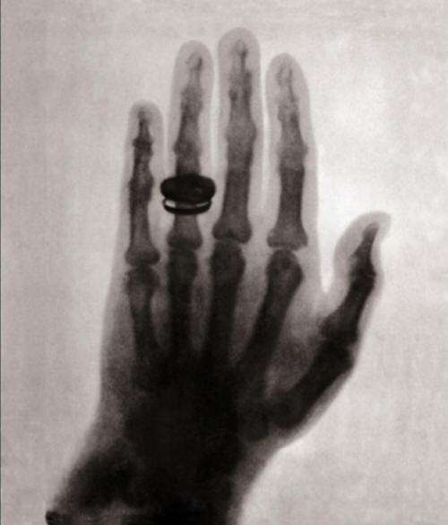 The first human X-Ray taken by Wilhelm Roentgen in...