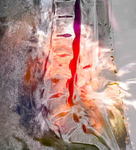 Light spinal stenosis, with color added for effect...