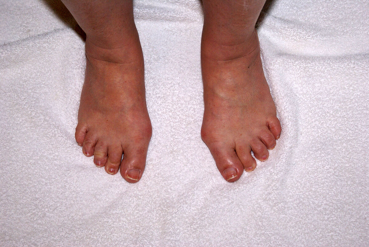 My wife's feet before Bunion surgery - May 2011 - ...