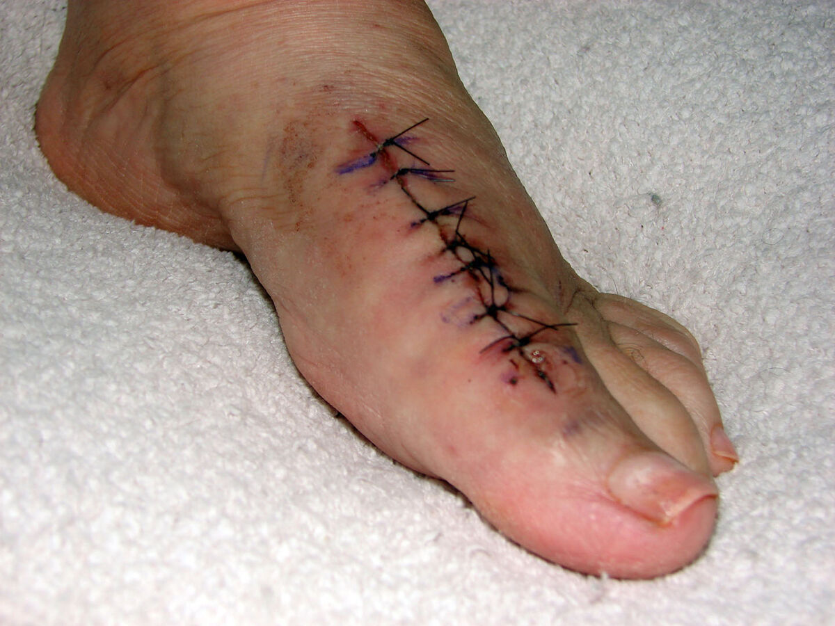 My wife's foot after Bunion surgery - November 201...